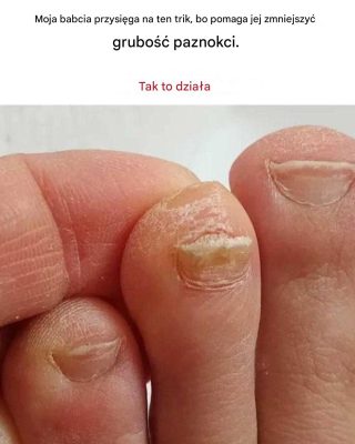 Jak zredukować grube paznokcie u stóp