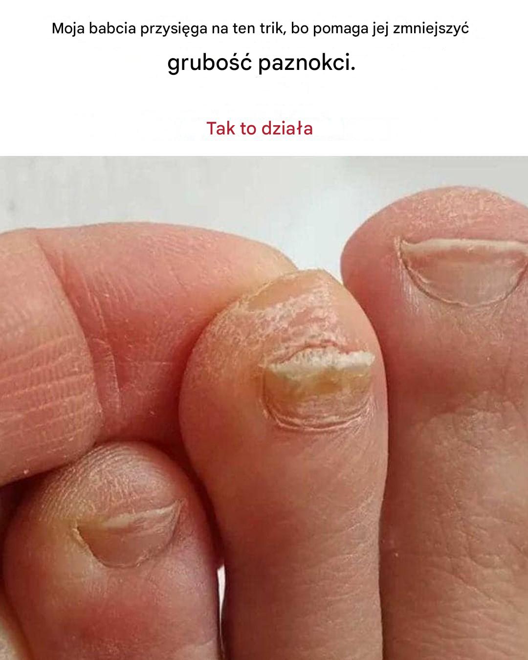 Jak zredukować grube paznokcie u stóp